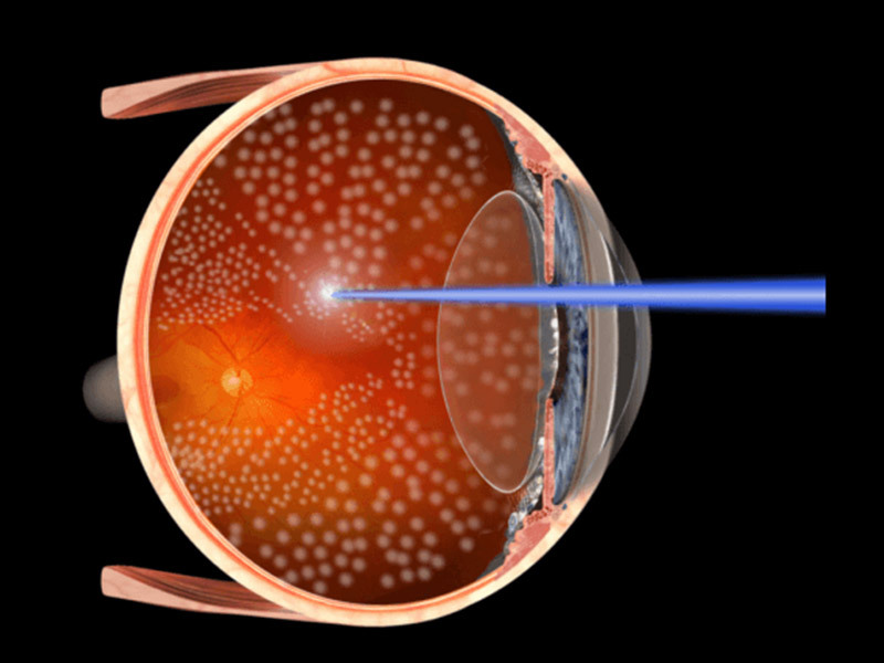 ¿Qué es la retinopatía del prematuro? 2026