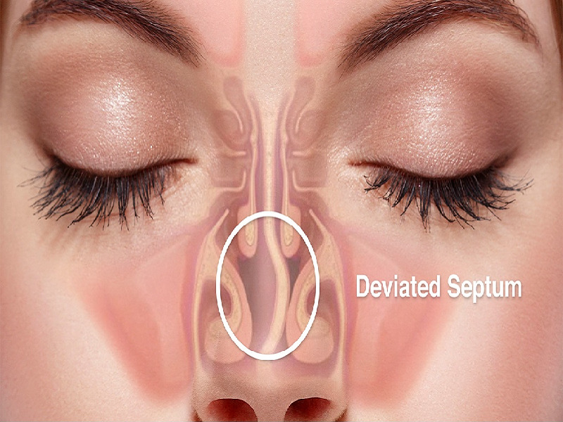 Deviated septum : causes and symptoms Deviated septum : causes and symptoms