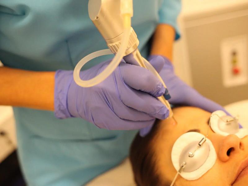 Co² fractional laser: When is it needed? 2026