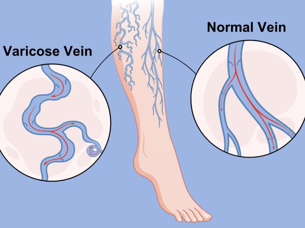 Treatment of obliterating arterial disease in Turkey 2026 Treatment of obliterating arterial disease in Turkey 2026
