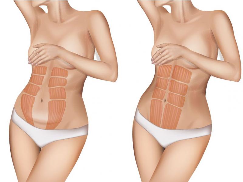 diastase abdominale diastase abdominale