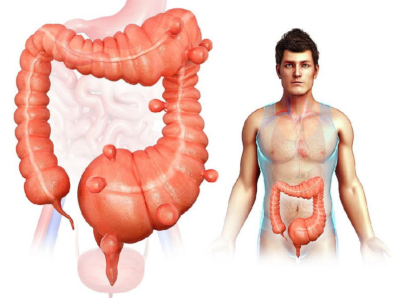 diverticulosis diverticulosis