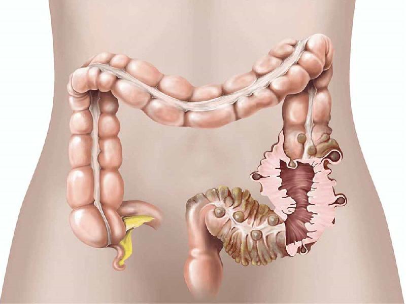 Symptômes de la diverticulose colique Symptômes de la diverticulose colique