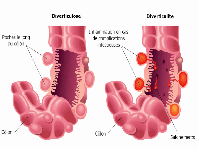 Diverticulose colique et diverticulite Diverticulose colique et diverticulite