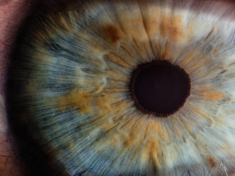 What is glaucoma? 2026