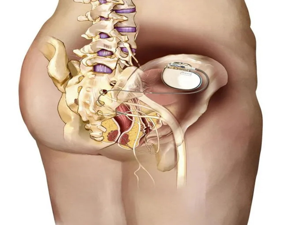 Stimulation nerveuse sacrée (SNS) Stimulation nerveuse sacrée (SNS)