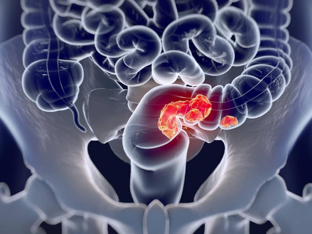 Maladie de Crohn Maladie de Crohn