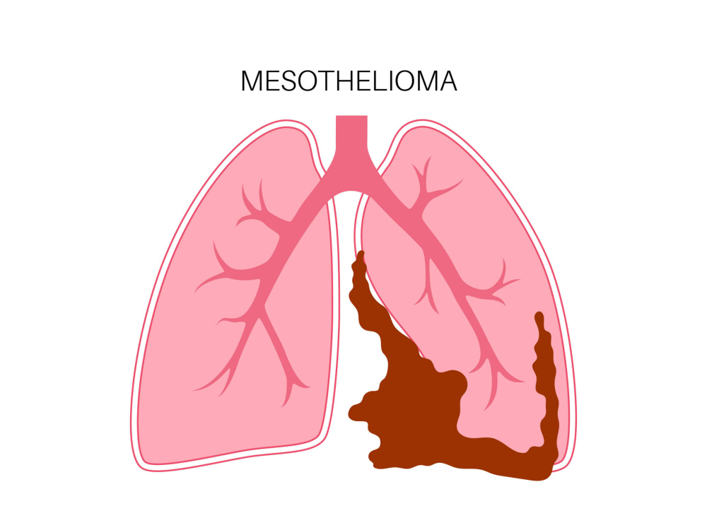 Malignant pleural mesothelioma: An overview 2026 Malignant pleural mesothelioma: An overview 2026