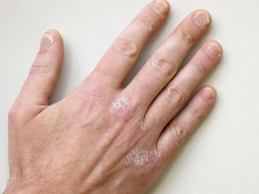 Psoriasis Psoriasis