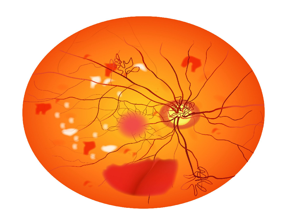 Diabetic retinopathy symptoms Diabetic retinopathy symptoms