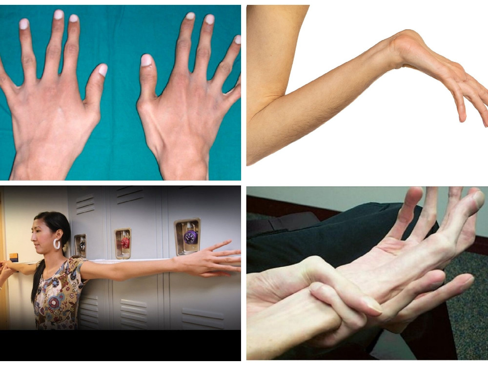 Causes and symptoms of Marfan syndrome Causes and symptoms of Marfan syndrome