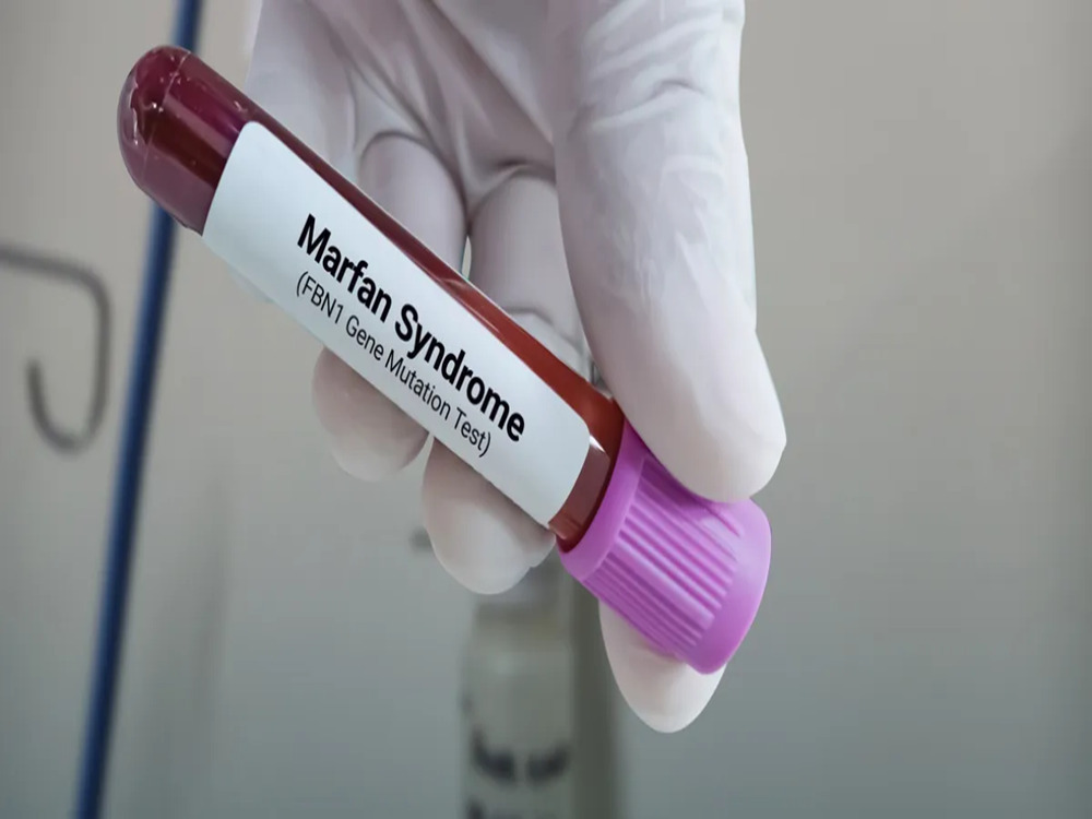 Непрерывное наблюдение за синдромом Марфана в Турции 2026 Непрерывное наблюдение за синдромом Марфана в Турции 2026
