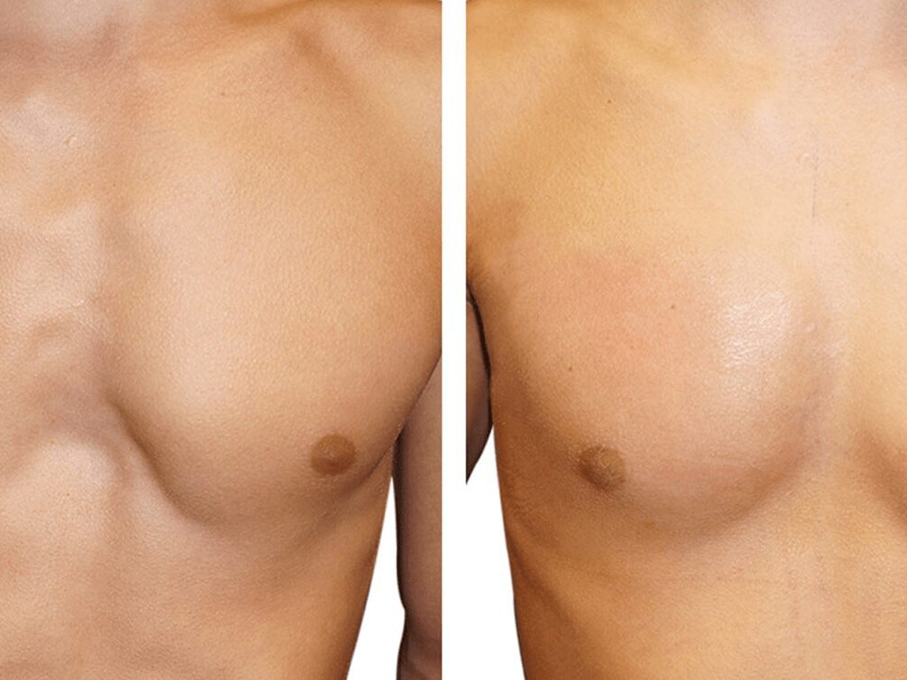 What is agenesis of the pectoralis muscle? 2026 What is agenesis of the pectoralis muscle? 2026
