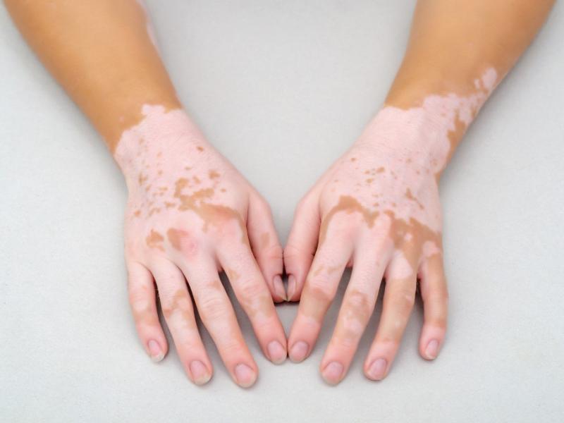 Traitement du Vitiligo Turquie Traitement du Vitiligo Turquie