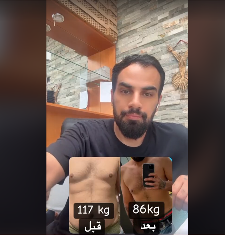 Ali Barzan : “La liposuccion laser a changé mon rapport à mon corps”